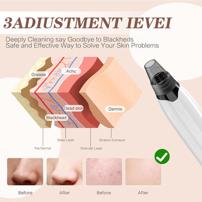 ✨ Advanced Blackhead Remover with Heating & Smart Suction Control